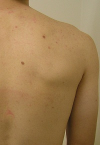 Back_Acne_2_After_2_Treatments-200x289