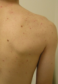 Back_Acne_2_Before-200x289