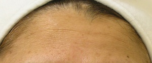 Fine_Lines_Before-2-300x125